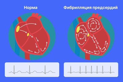 Мерцательная аритмия: что это такое, как лечить и жить с этим состоянием