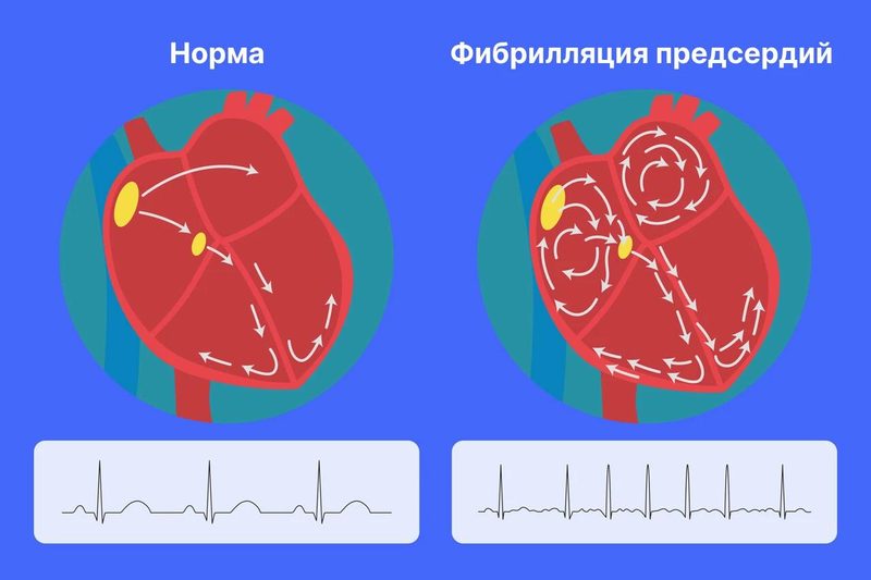 Мерцательная аритмия: что это такое, как лечить и жить с этим состоянием